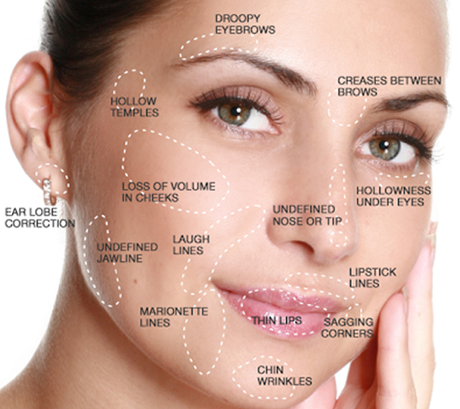 Understand the Basics of Dermal Fillers