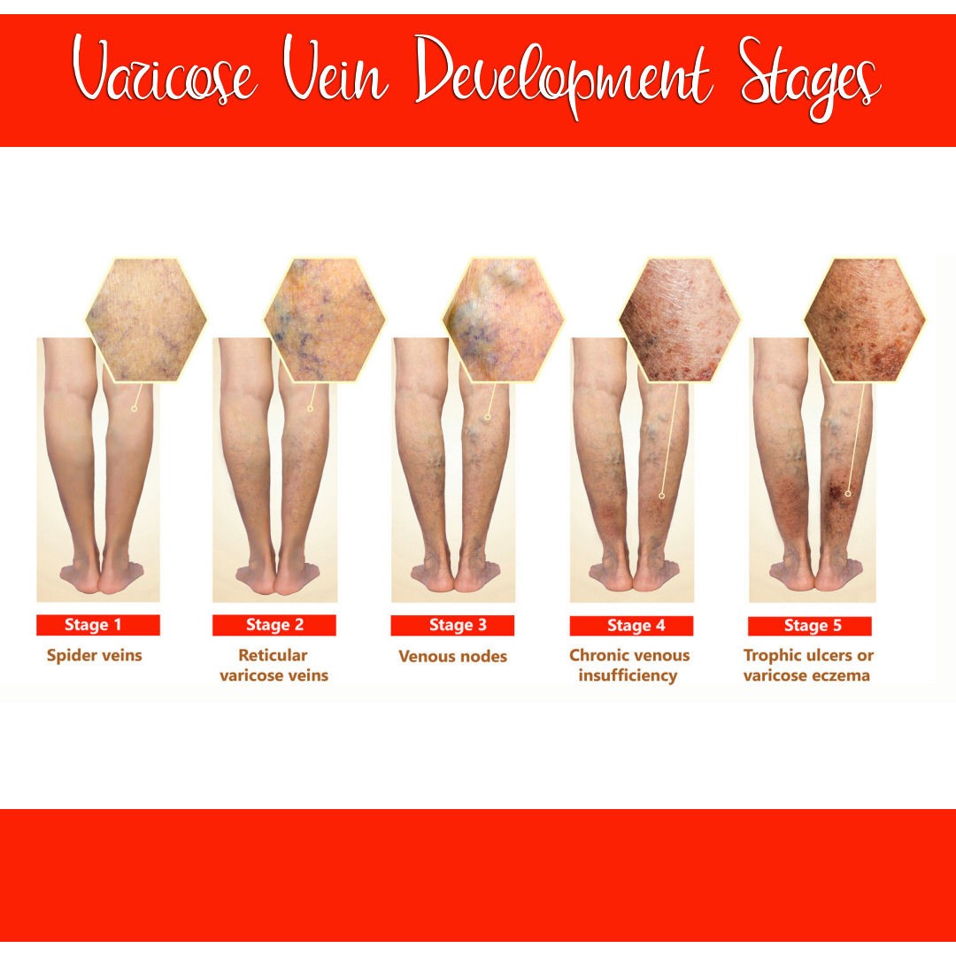 Varicose Veins – What You Need to Know